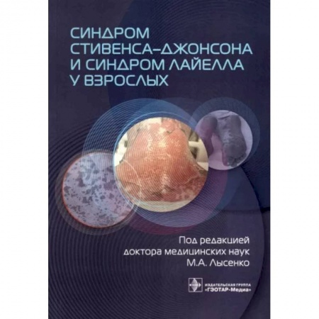 Терапия. Пульмонология, книга Синдром Стивенса-Джонсона и синдром Лайелла у взрослых купить по скидке